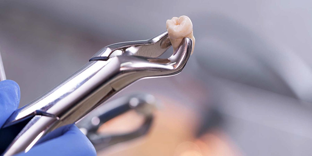 tooth being extracted