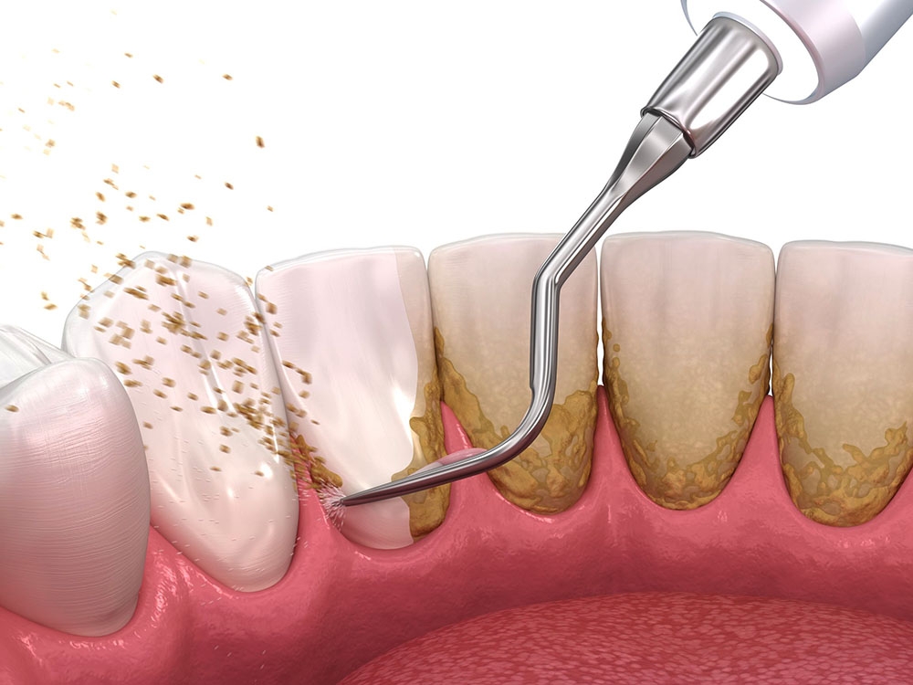 removing of gum plaque