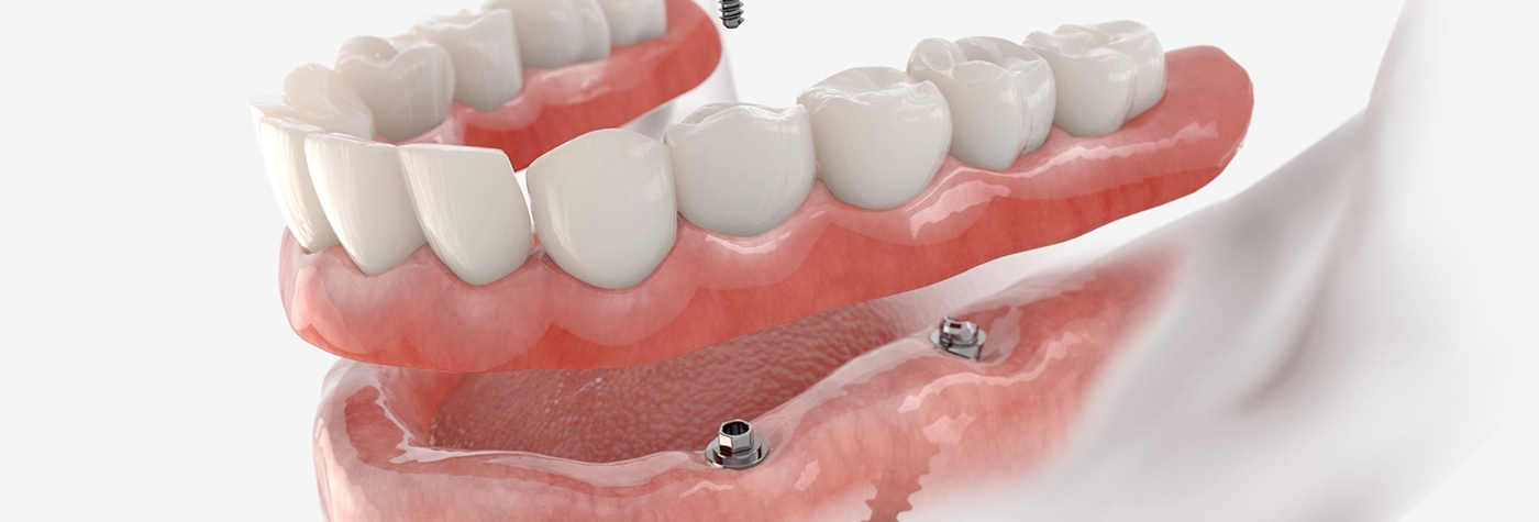 closeup of all-on-x work