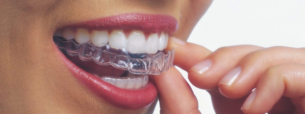 girl putting in invisalign set