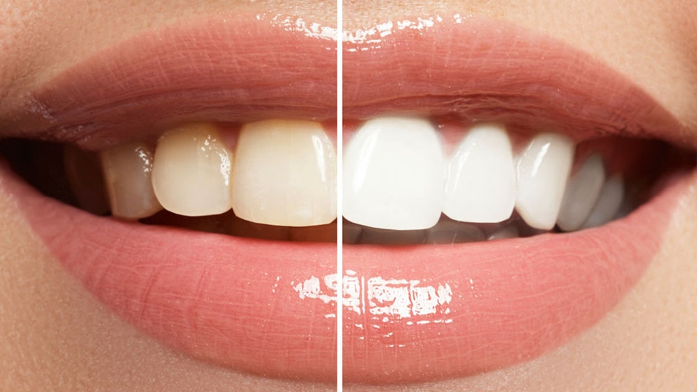 before and after smile