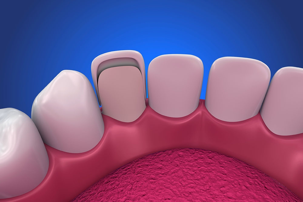 3d model of a veneer cap behind tooth
